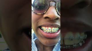 Damon Braces System: 2nd wire change