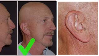 Facelifts For The Follically-Challenged. Plastic Surgery Hot Topic With Rod Rodrich, Md