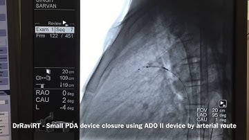 DrRaviRT- BAV + PDA device closure using ADO II device by arterial route