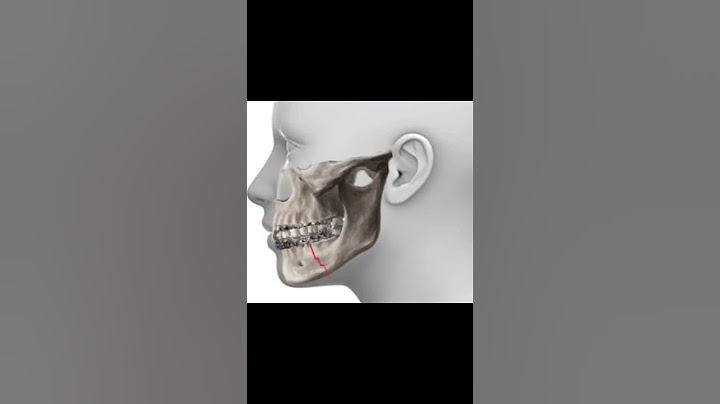 Fracture of Mandible | ORIF | Sijo-Rocky fight | Bigg Boss | Scribble sparks #biggboss #sijo #bbms6