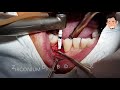[주의! 수술 영상입니다!] 임플란트 지르코니움 드릴 사용 임플란트 수술 Implant 1st stage surgery using Zirconium drill