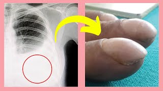 Top 10 WARNING signs of Lung Cancer