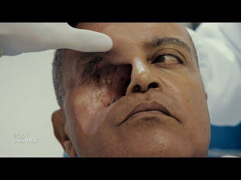 Vidéo: La Taupe Sur Le Visage S'est Transformée En Une énorme Tumeur - Vue Alternative