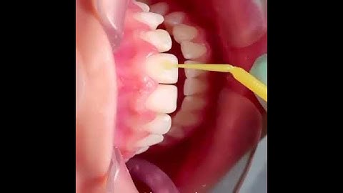 How to install braces brackets