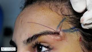 Cat eye ( eyebrow thread lift ) - Dr. Noury Adel