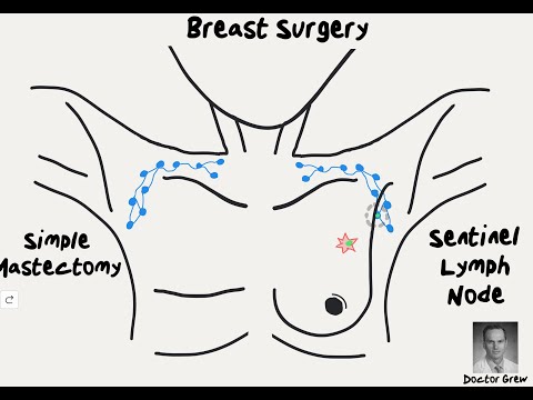 Doctor Explains Breast Cancer Surgery Options