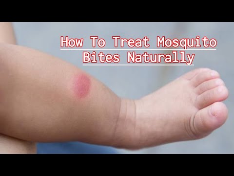 वीडियो: छोटे बच्चे पर मच्छर के काटने का धब्बा कैसे लगाएं