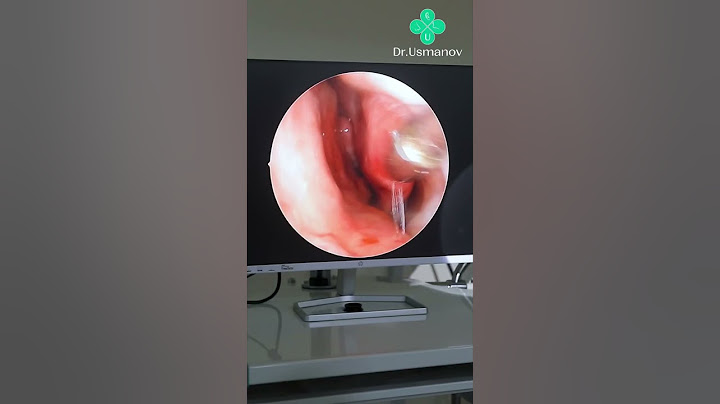 Septokonxoplastika jarrohlik amaliyoti #septokonxoplastika #operatsiya #lor #kasallik