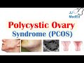 Polycystic Ovary Syndrome (PCOS) - Causes, Risks and Treatments