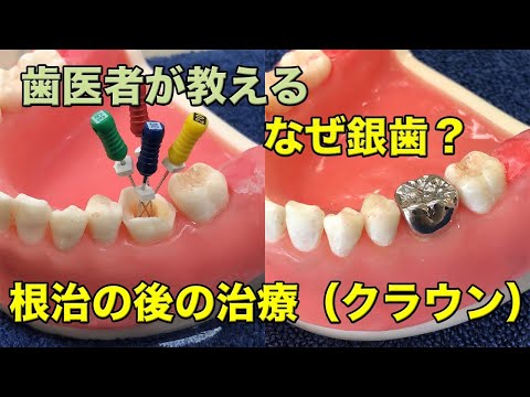 [Yokohama Totsuka @ Naito Dental] Treatment after crown (crown)