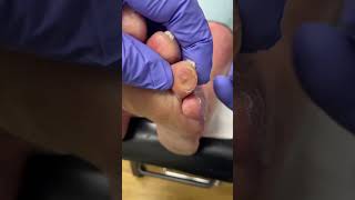 Dive Into This Corn & Callus Removal! Why Bear The Pain? #Podiatry #Toehealth #Australia