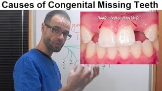 Causes of Dental Anomalies, Congenital Missing/Absence of Permanent Teeth by Dr Mike Mew