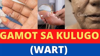 Gamot Sa Kulugo: Mga Paraan Para Mawala Ito Gamot Sa Kulugo: Mga Paraan Para Mawala Ito