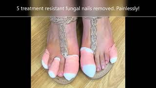 Thick Nails Paint Remove? In clinic with podiatrist Katrina Waller -  Compleet Feet