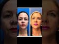 Reno/Tahoe Morpheus+CO2 Laser Healing from Skin Tightening and Resurfacing | Dr. Erez Dayan