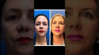 Reno/Tahoe Morpheus+CO2 Laser Healing from Skin Tightening and Resurfacing | Dr. Erez Dayan screenshot 5