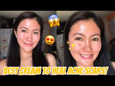 HOW TO REMOVE ACNE SCARS & PIMPLE MARKS | MADECA DERMA | Sasay