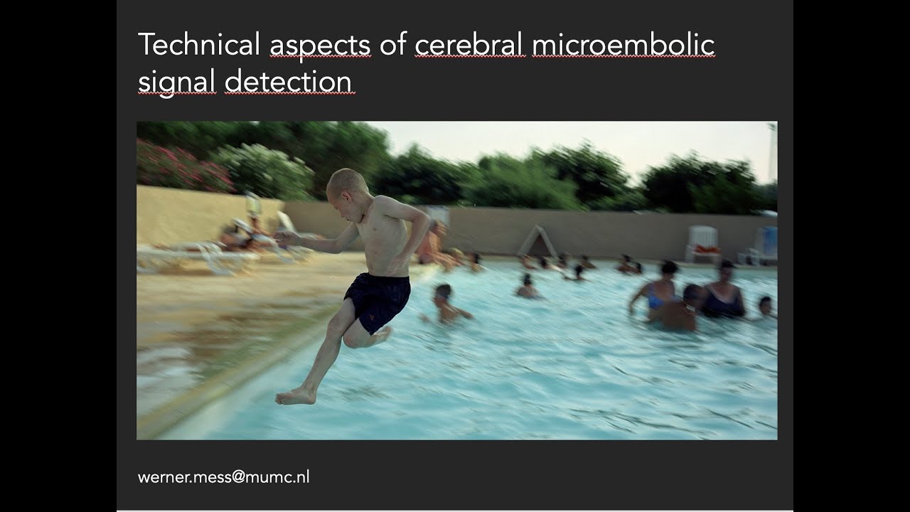 Signal Mess Technical Aspects of Cerebral Microembolic Signals (MES) by Werner H ...
