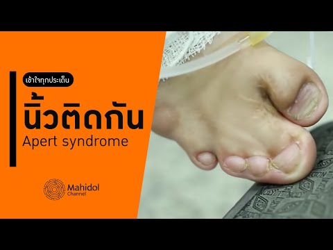 นิ้วติดกัน (Apert syndrome) รักษาอย่างไร เข้าใจทุกประเด็นในคลิปนี้ [หาหมอ by Mahidol Channel]