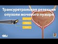 Трансуретральная резекция опухоли мочевого пузыря -ТУР мочевого пузыря (EAU - TURBT RU)