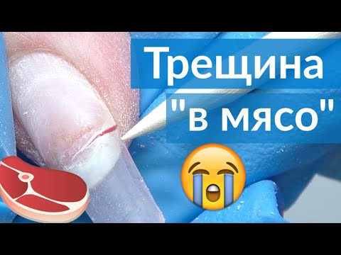 Трещина на ногте &#55357;&#56881; Что делать? Ремонт без снятия ногтя