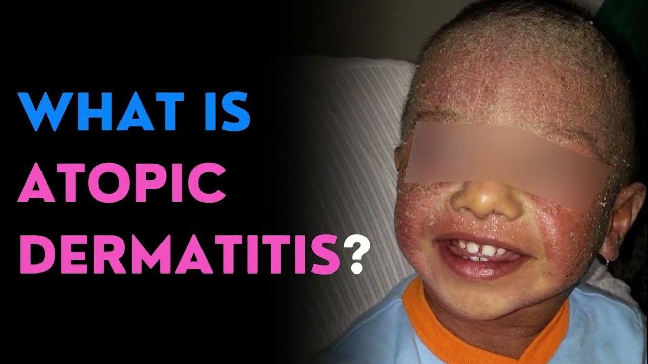 Atopic Dermatitis Find Relief from Eczema The Best Homeopathic