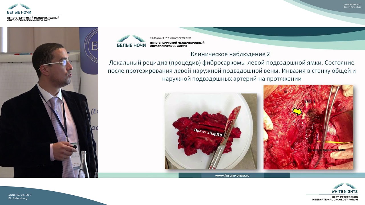 Клинические результаты хирургического лечения забрюшинных сарком с ...