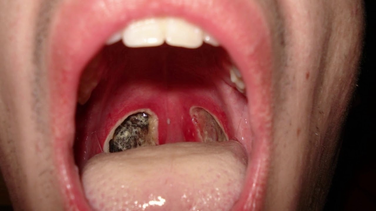 My Tonsil Stones! Do I Need a Tonsillectomy? - YouTube