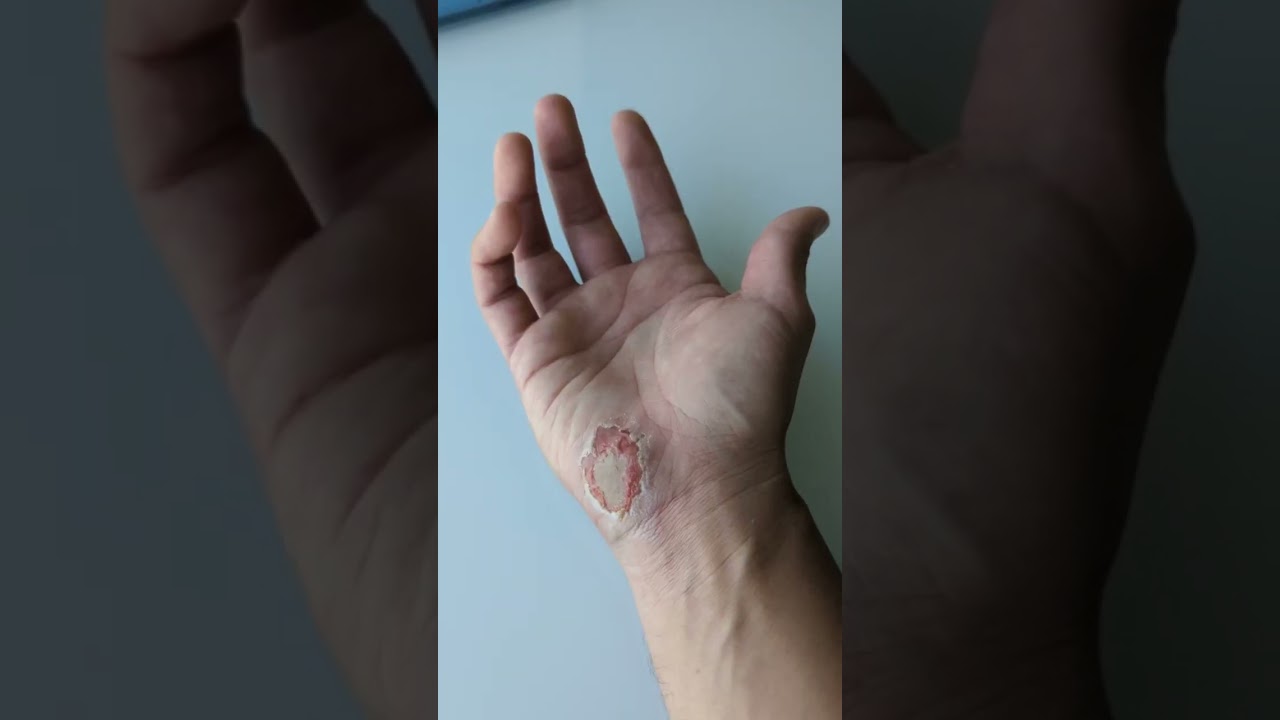 Hydrocolloid Gel Bandages Experience