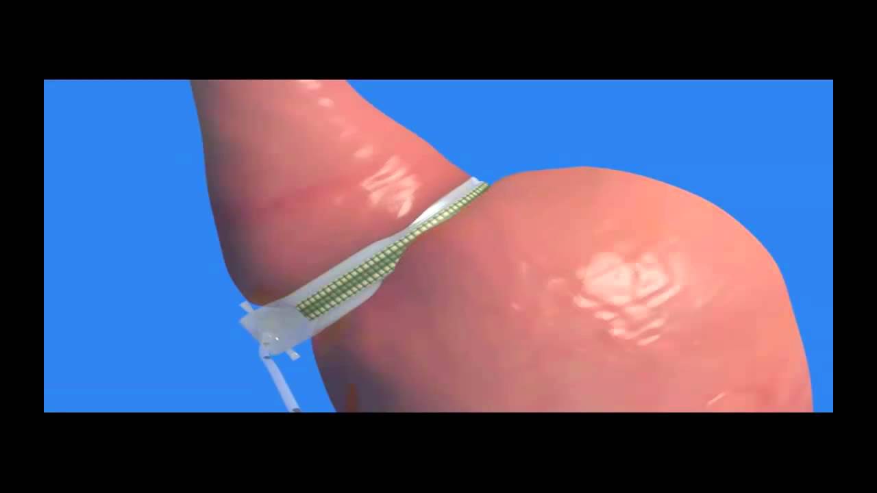 Bioring Gastric Band Educational Video YouTube