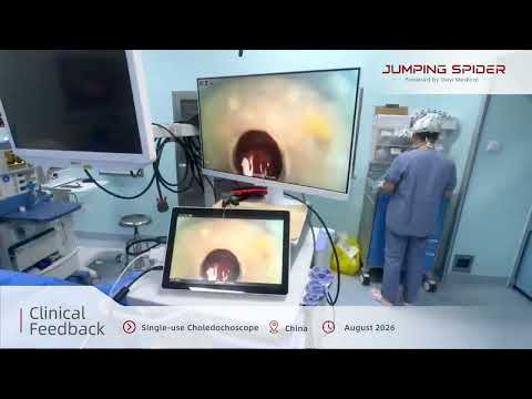 Clinical Application in China | 14.7Fr Single-use Choledochoscope HD imaging