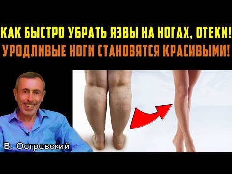 КАК БЫСТРО УБРАТЬ ЯЗВЫ НА НОГАХ, ОТЕКИ НОГ! УРОДЛИВЫЕ НОГИ СТАНУТ КРАСИВЫМИ! Варикоз, болезнь рейно.