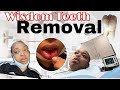 I got FOUR Wisdom Teeth Removed | *Oral Surgery VLOG * + recovery tips 🦷