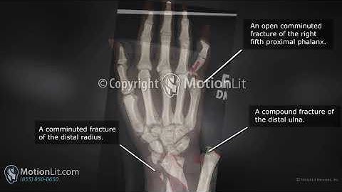 3D Animation Shows Mechanism of Compound Wrist Fracture Injury
