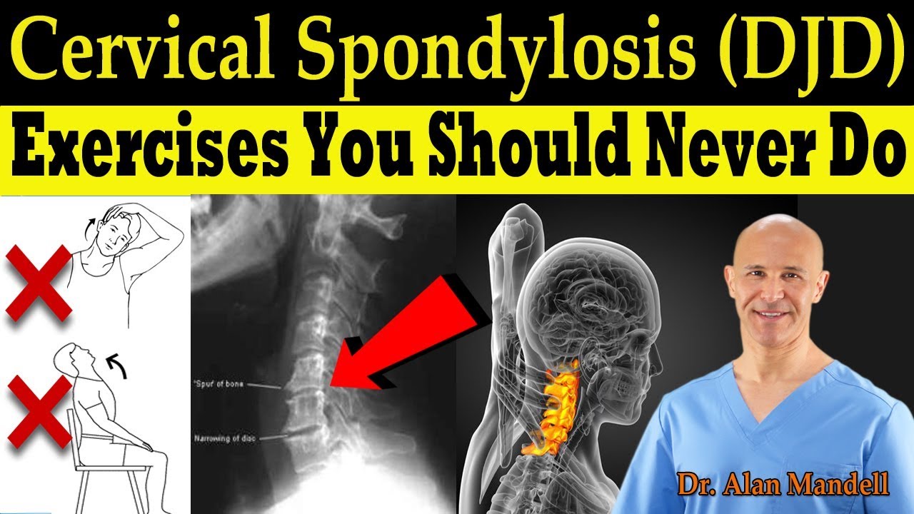 Cervical Spondylosis Exercises Chart