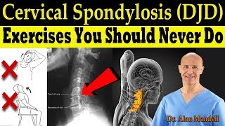 Cervical Spondylosis (DJD) Exercises You Should Never Do (Correct Exercises) - Dr. Alan Mandell, DC screenshot 1