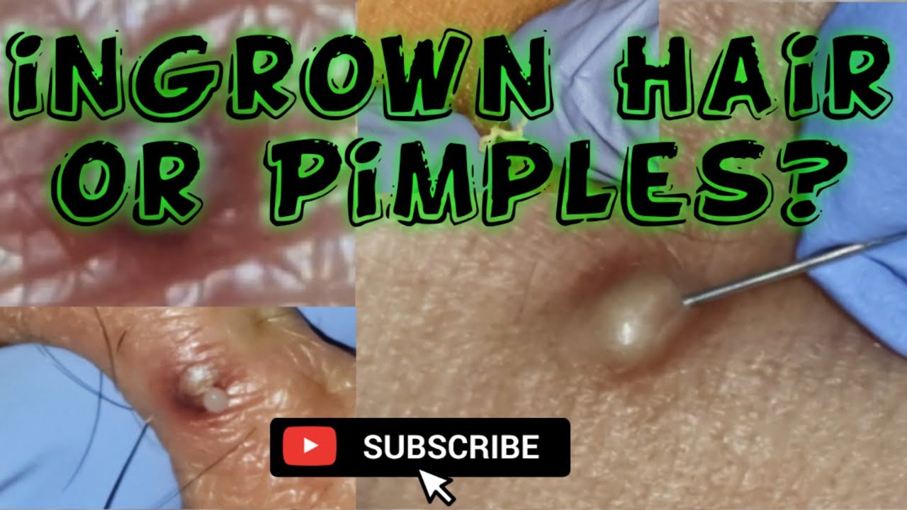 How to remove a ingrown hair that is deep