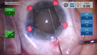 Dense Cataract and Small Pupil: Iris Hook Technique