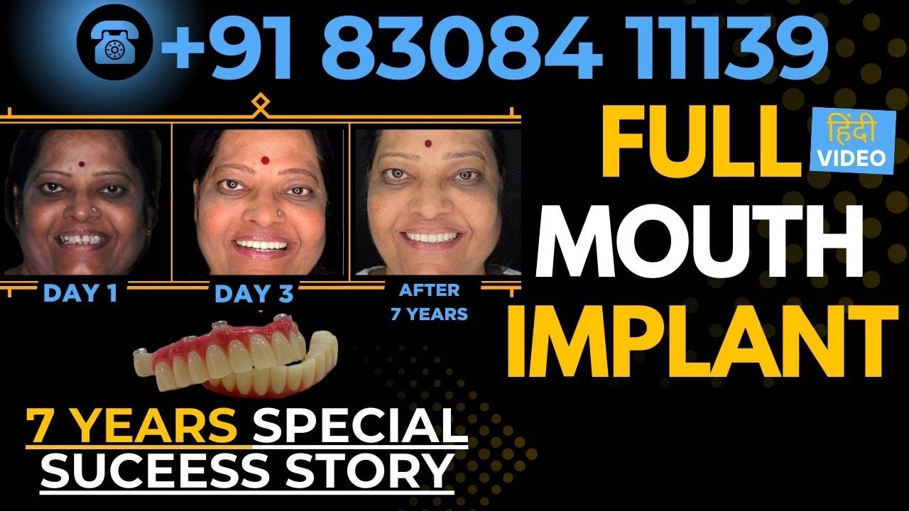 Full Mouth Implant: 7-Year Success Story | PreciGem Dental Care