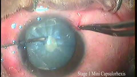 Safe Cataract Surgery in  Intumescent White Cataracts (With Voice Over)