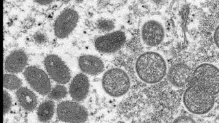 Here's what we know as monkeypox cases climb in US