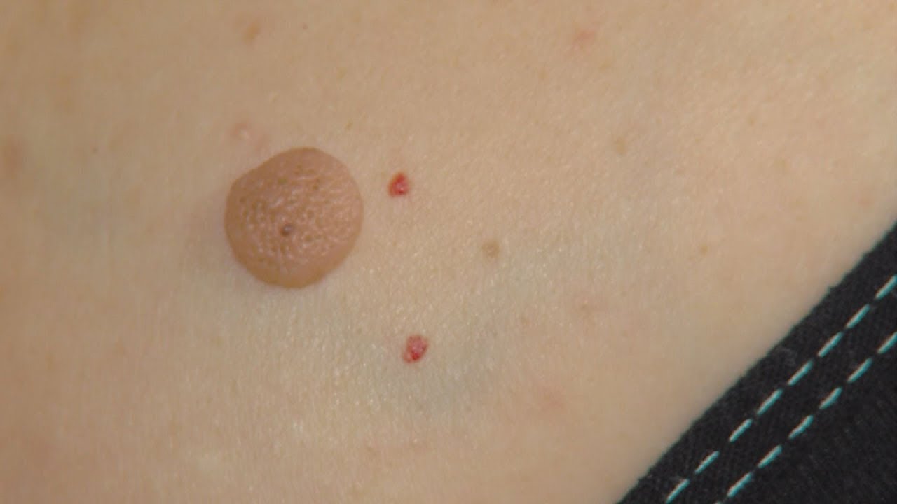 hpv tedavisi dondurma