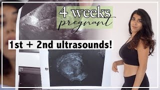 4 Weeks Pregnant | Early Ultrasound and Ectopic Pregnancy Scare?
