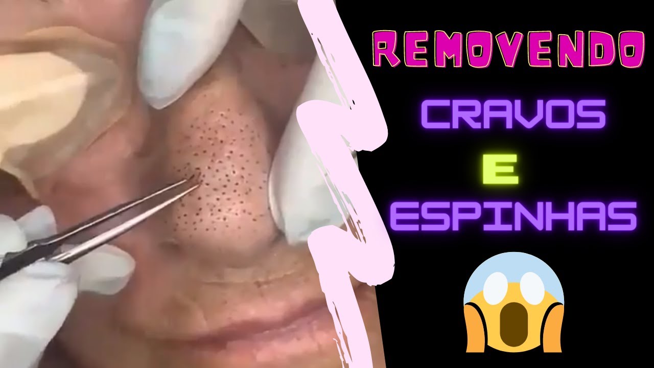 Removendo cravos e espinhas gigantes do rosto - YouTube