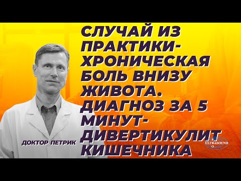 Случай из практики - хроническая боль внизу живота. Диагноз за 5 минут. Дивертикулит кишечника.