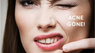 How to Treat Acne Scars? - Acne Scars Home Remedy -  HealthTip