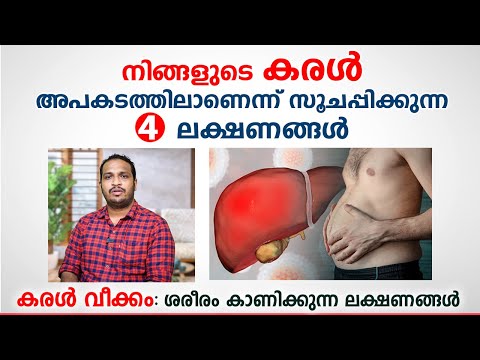 നിങ്ങളുടെ കരൾ അപകടത്തിലാണെന്ന് സൂചപ്പിക്കുന്ന 4 ലക്ഷണങ്ങൾ | Liver Cirrhosis Malayalam | Arogyam