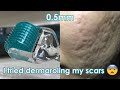 I tried dermarolling my ACNE SCARS! | Demo + Review