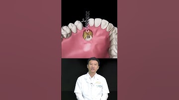 Kéo Răng Mọc Ngầm