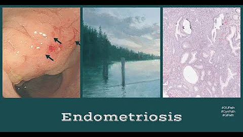 Endometriosis- pathology, distribution, pathogenesis